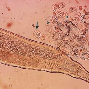 Worms mate in man’s eyes, get plucked out right before larvae burst out