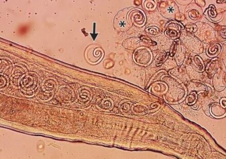 Worms mate in man’s eyes, get plucked out right before larvae burst out